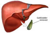 Laparoscopic Cholecystectomy